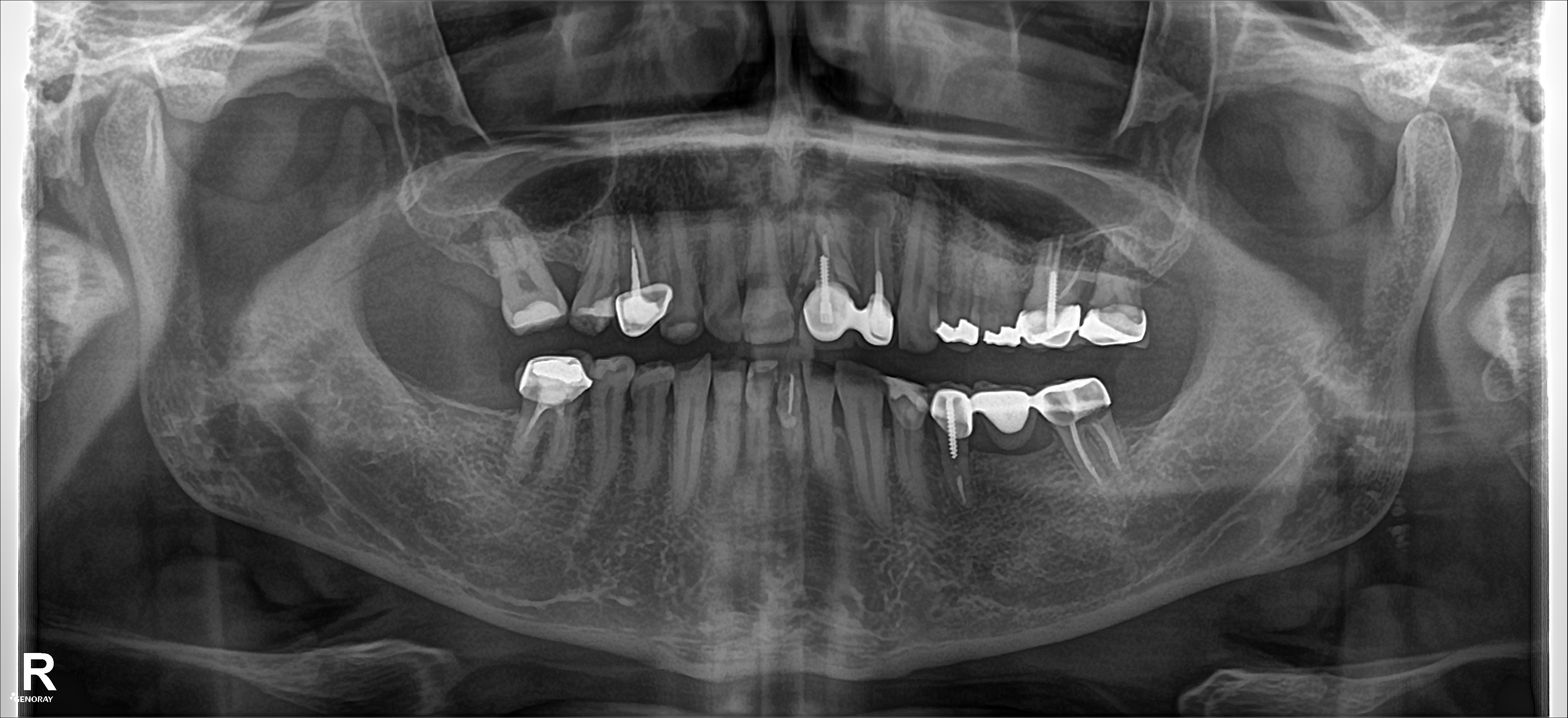 Panoramic dental X-ray