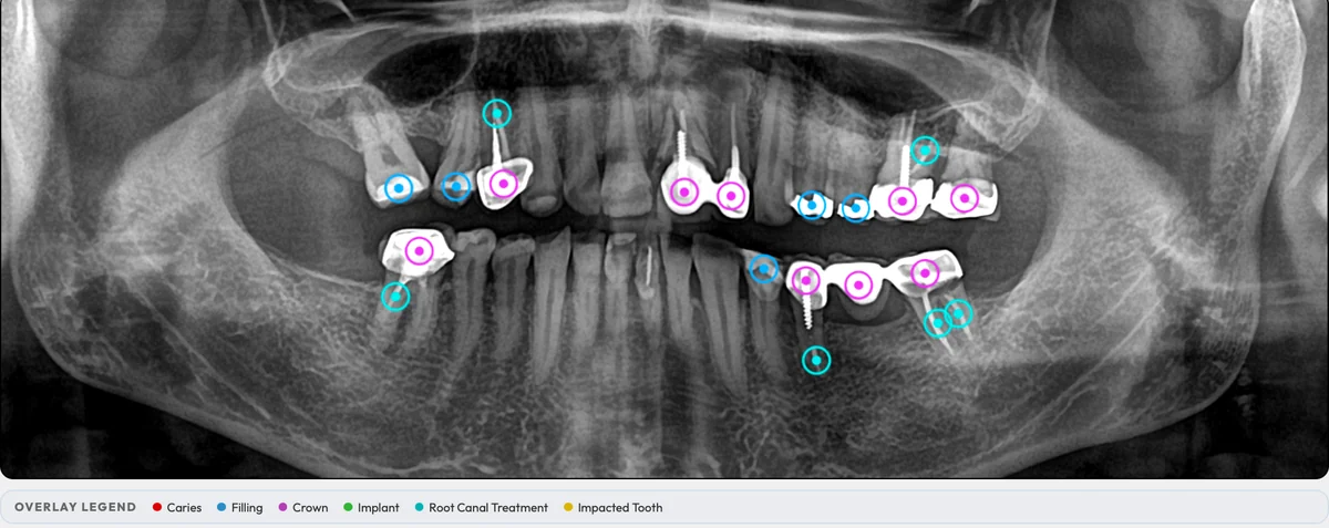 Lumben dentist review screen: a panoramic X-ray with AI-assisted overlays for fillings, crowns and root canal treatments, and the overlay legend.
