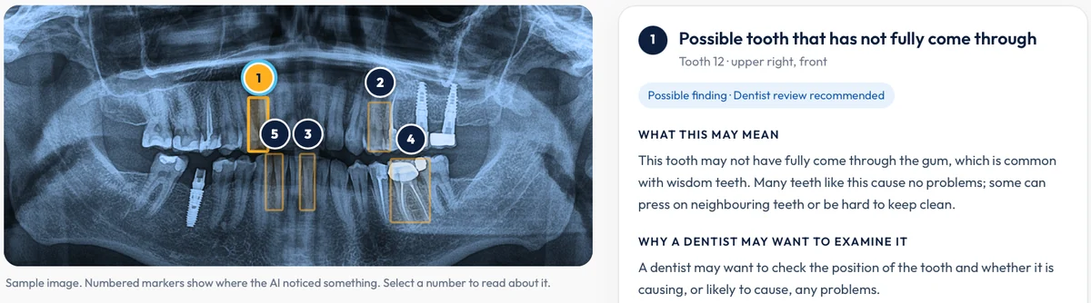Lumben patient report: numbered markers on a sample X-ray and a plain-language explanation of one possible finding.