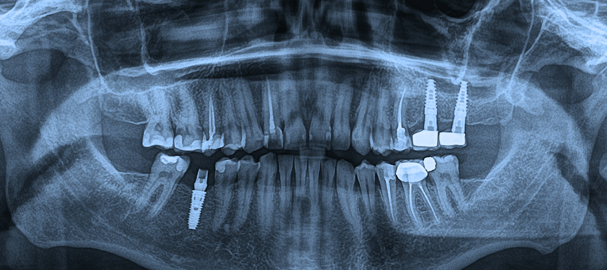 Panoramic dental X-ray
